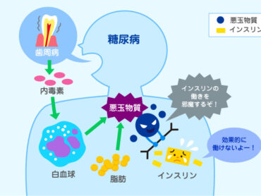 糖尿病と歯周病の関係のアイキャッチ画像