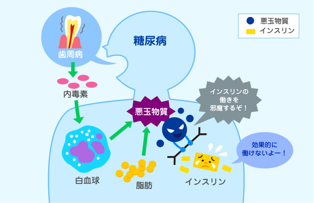 糖尿病と歯周病の関係のアイキャッチ画像