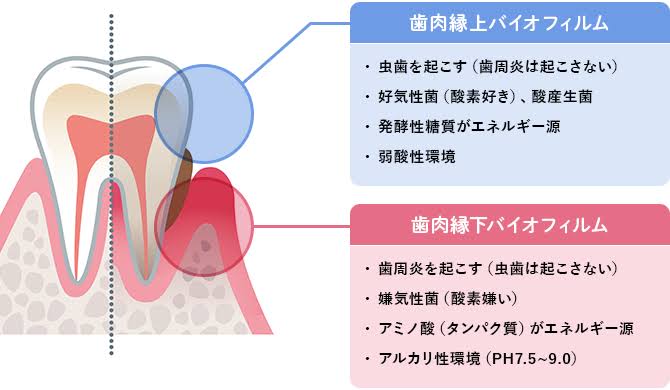 歯石についてのアイキャッチ画像