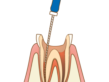 根管治療のアイキャッチ画像