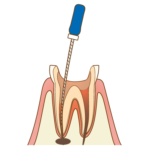 根管治療のアイキャッチ画像