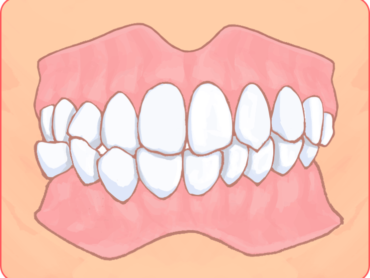 交叉咬合についてのアイキャッチ画像