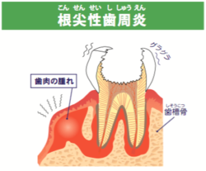 根尖性歯周炎のアイキャッチ画像