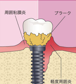 インプラント周囲炎についてのアイキャッチ画像