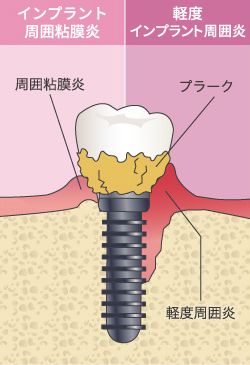 インプラント周囲炎についてのアイキャッチ画像