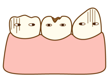 虫歯の進行についてのアイキャッチ画像