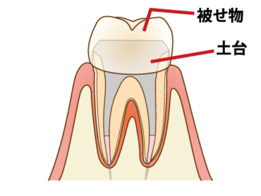 歯の根の治療の注意事項についてのアイキャッチ画像