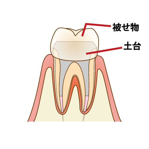 歯の根の治療の注意事項についてのアイキャッチ画像