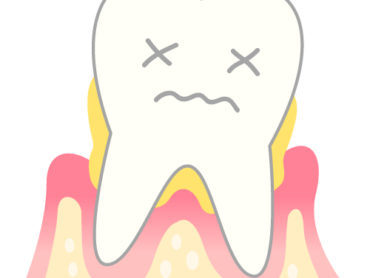 歯肉の腫れの原因についてのアイキャッチ画像