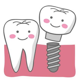 インプラント歯周炎についてのアイキャッチ画像