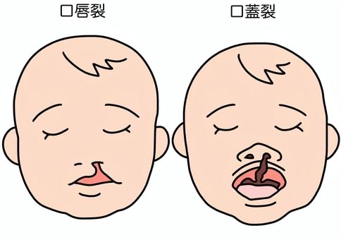 口唇口蓋裂についてのアイキャッチ画像