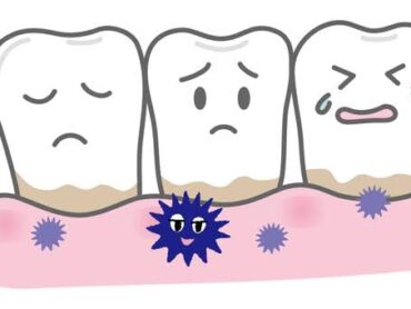 プラークが歯石に変化するまでの日数のアイキャッチ画像