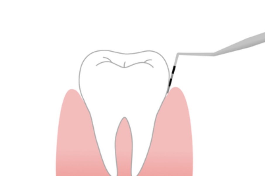 歯周ポケットについてのアイキャッチ画像