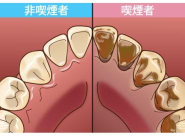 喫煙と歯の健康についてのアイキャッチ画像