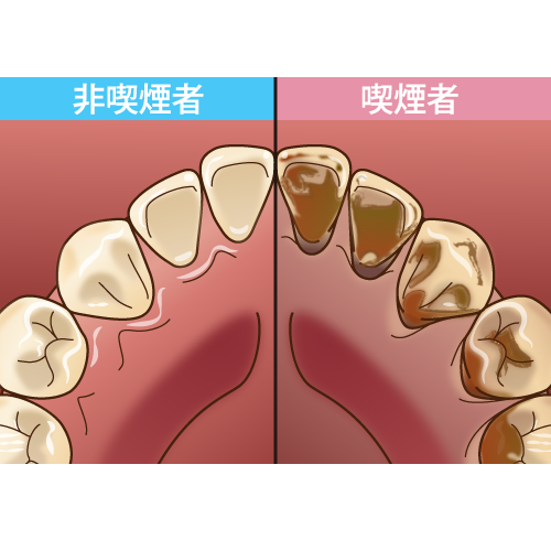 喫煙と歯の健康についてのアイキャッチ画像