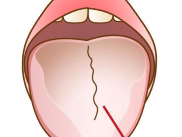 口臭の原因　舌苔についてのアイキャッチ画像