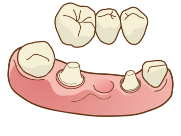 ブリッジ治療のリスクとメリットについて知ろうのアイキャッチ画像