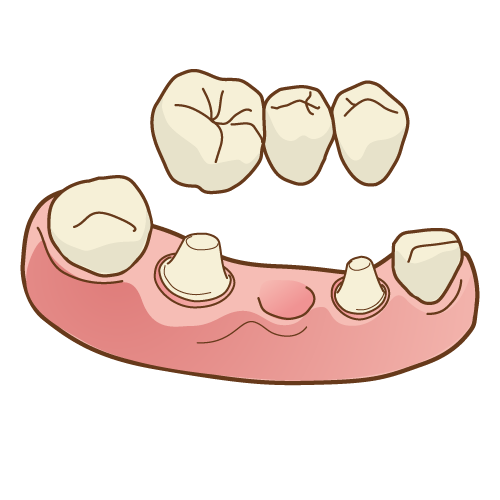 ブリッジ治療のリスクとメリットについて知ろうのアイキャッチ画像