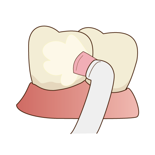 歯石についてのアイキャッチ画像