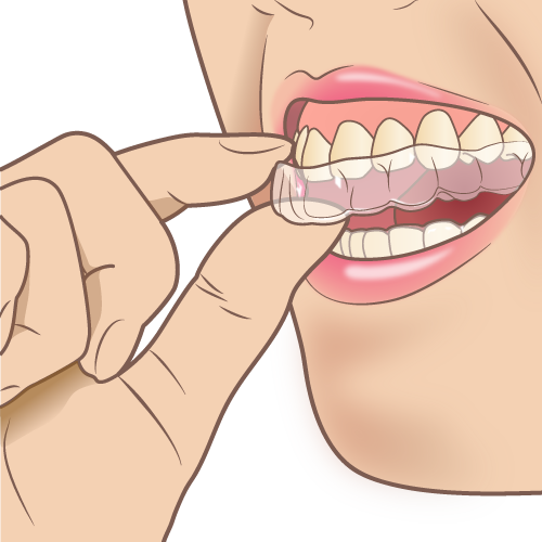 マウスピース矯正 - 歯並びを改善する快適な方法のアイキャッチ画像